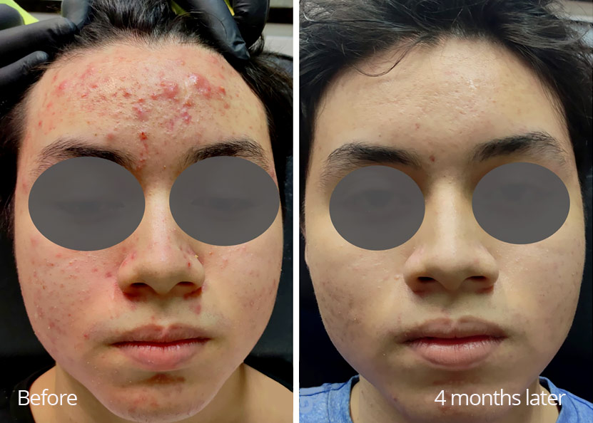 treatment for acne 