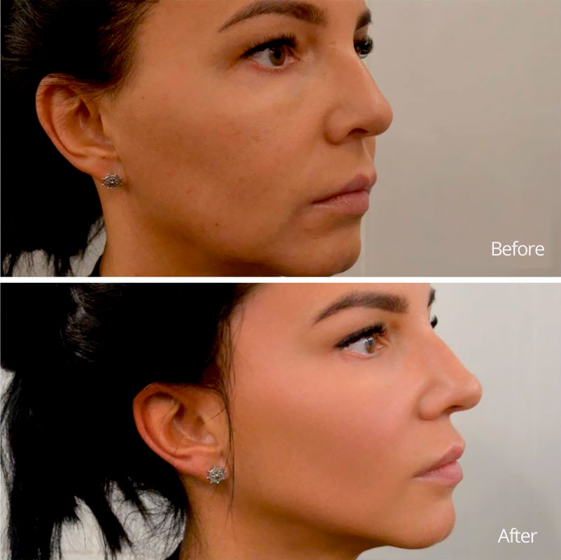 Real Results Facial Harmonization