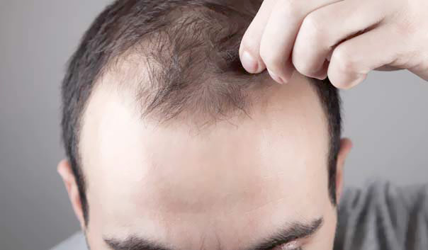 Alopecia androgénica 