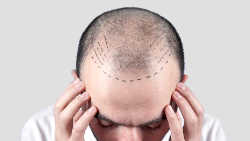 Tratamiento alopecia hombre