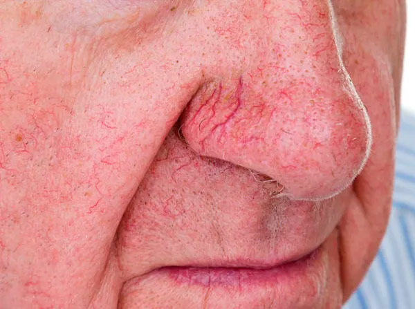  Facial Telangiectasia