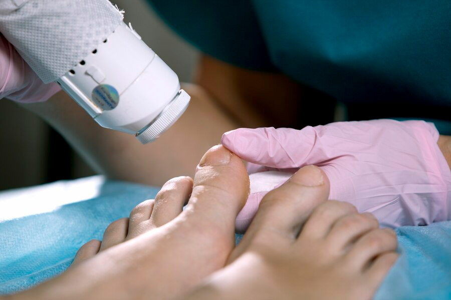 Laser treatment for toenail fungus