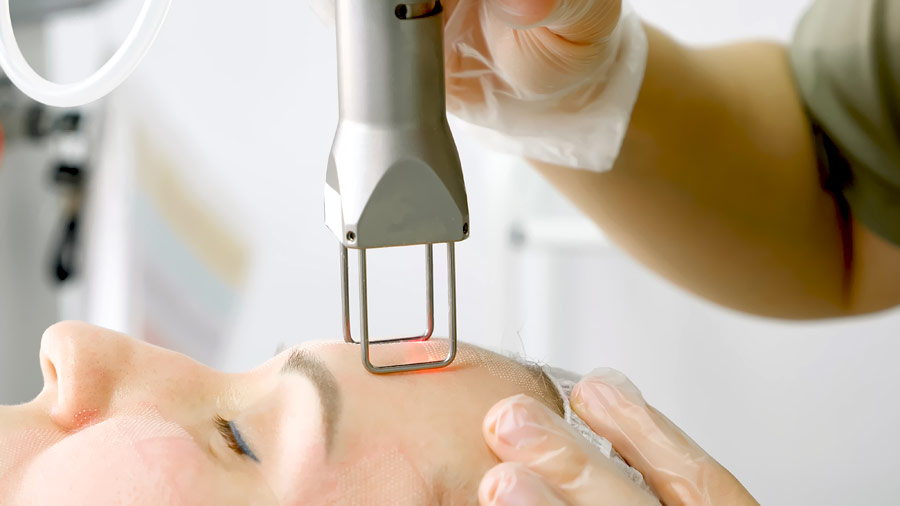 Por qué elegir láser co2