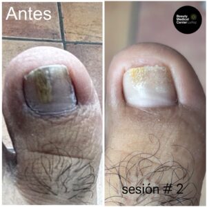 Laser treatment for nail fungus before and after, la paz
